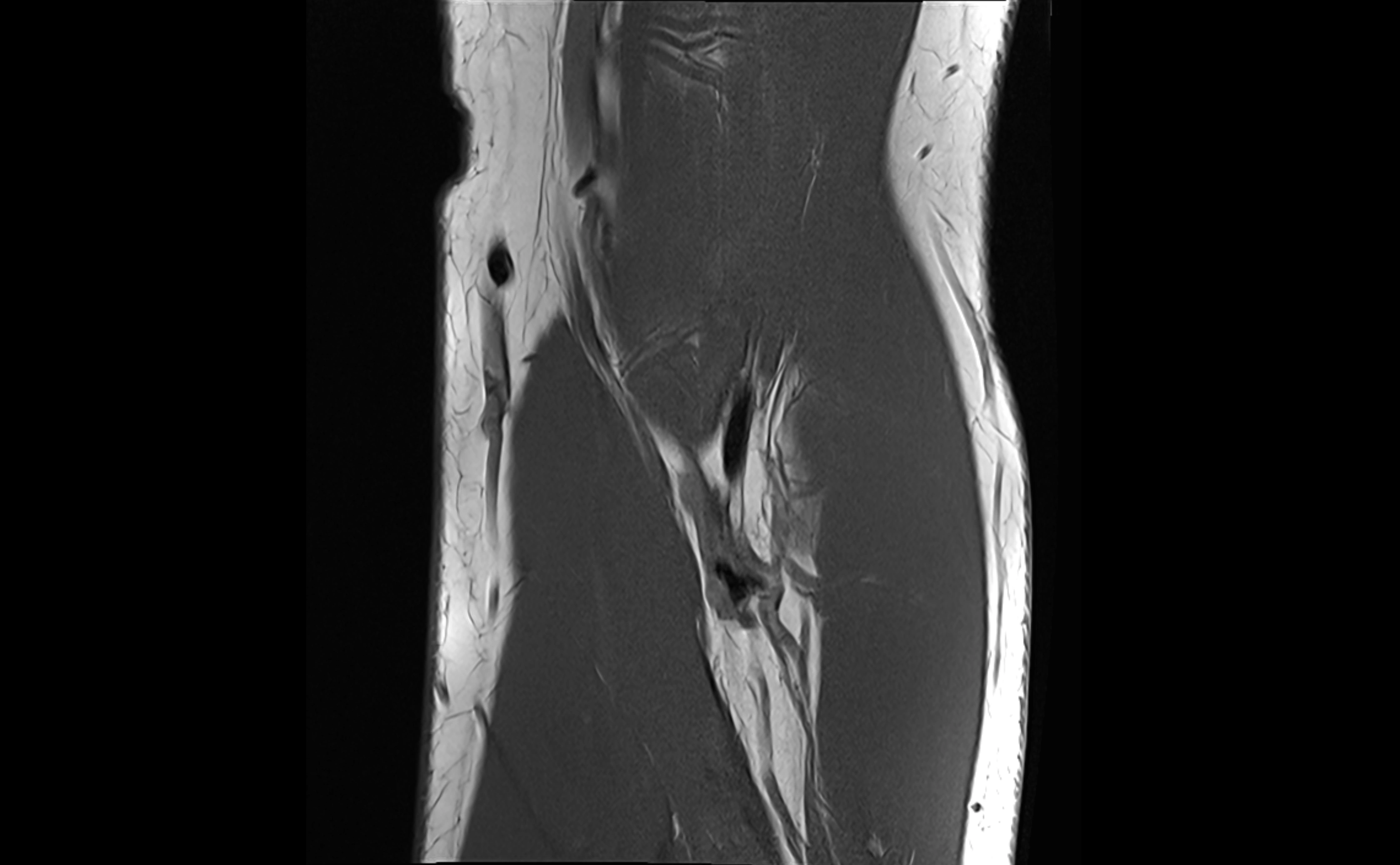 MRI elbow ligaments coronal cross sectional anatomy 3T  radiology  image-img-07001-00010.webp
